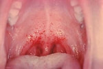 リウマチ熱・扁桃腺写真