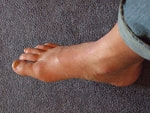 痛風・足写真