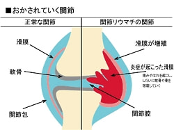 おかされていく関節