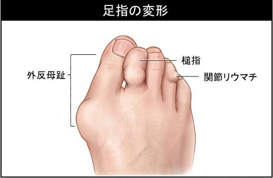 足指の変形・症状