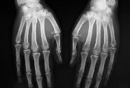 リウマチCT検査